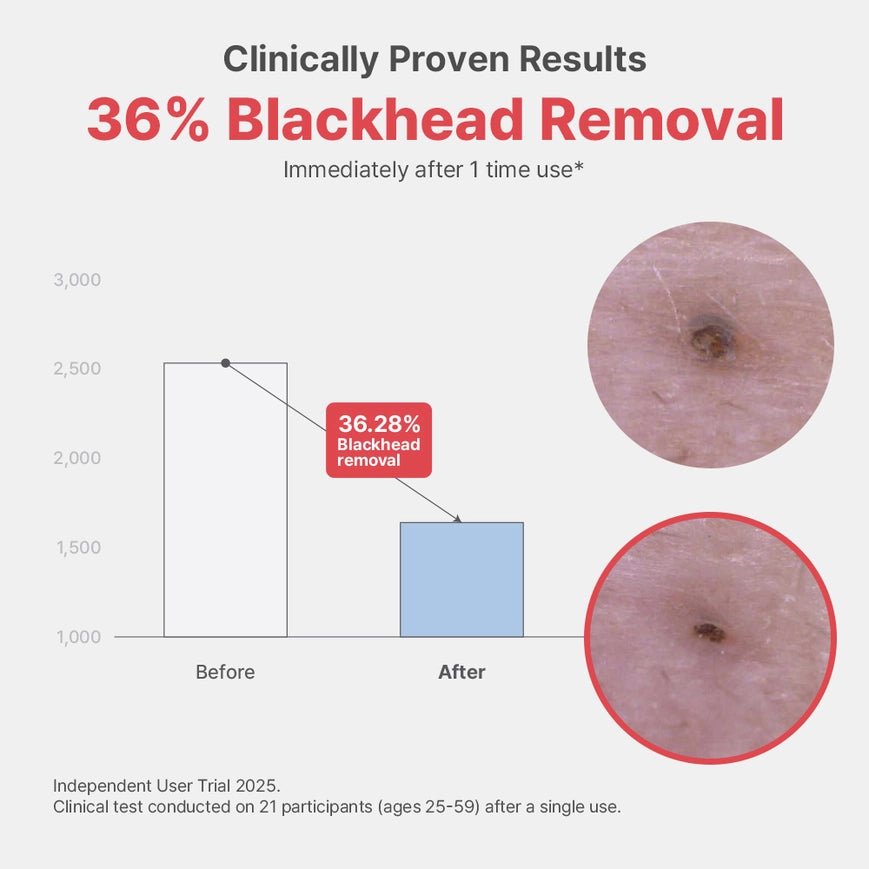 Clinically Proven Results: 36% Blackhead Removal after 1 use